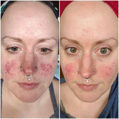 The patient was treated with oral ivermectin and subsequent topical permethrin resulting in complete and rapid clearing of the folliculitis. . How long ivermectin rosacea reddit